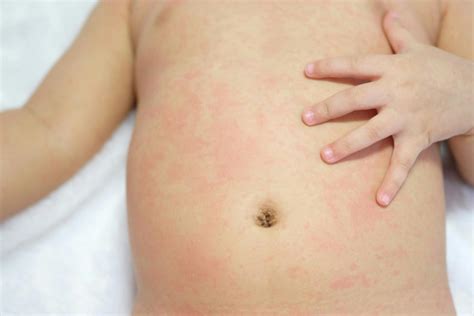 does viral meningitis cause a rash