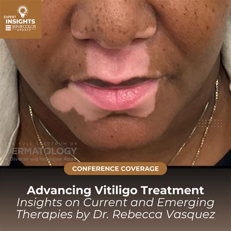 Does Vitiligo Go Away