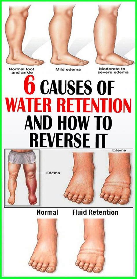 Does Voltaren Cause Fluid Retention