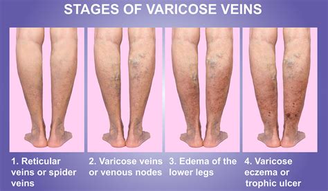 Does Weight Cause Varicose Veins