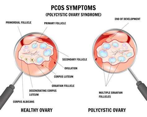 Does Weight Gain Cause Pcos