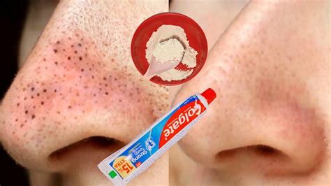 Does Wheat Flour And Toothpaste Remove Blackheads