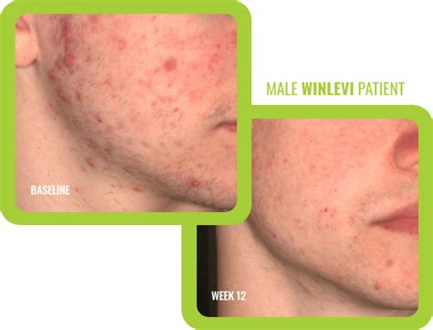 does winlevi help with acne scars