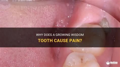 does wisdom teeth hurt while growing