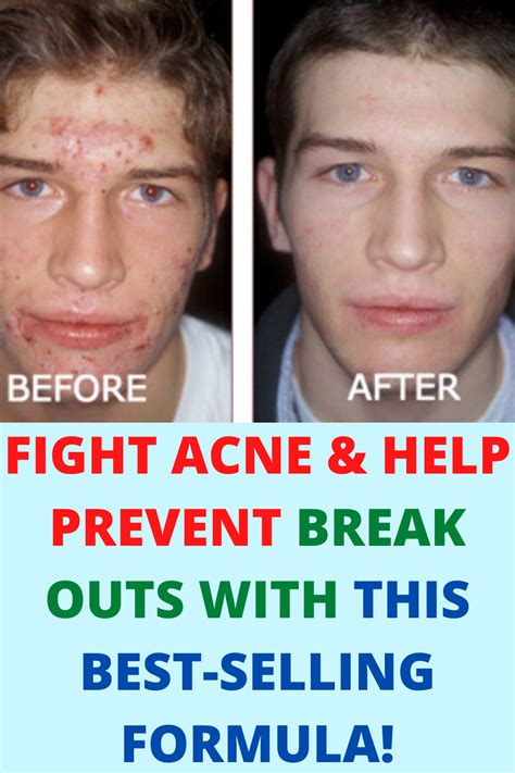 Does Working Out Help Acne? Discover the Surprising Connection