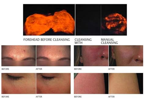Does clarisonic make a difference?