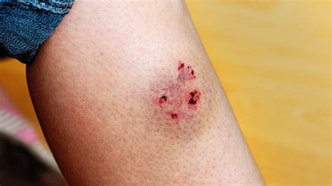 Effective Treatment for Dog Bite Wound Healing Process