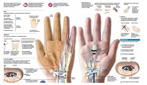 Dolor en los dedos de las manos - Médicos Líderes | Cirugía Plástica en