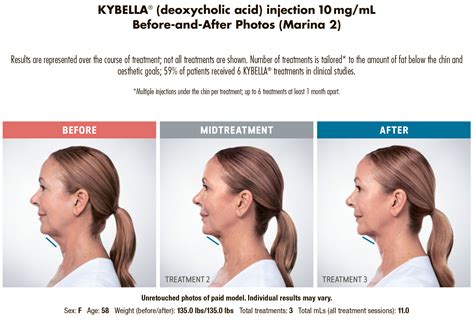 Belkyra® (Double Chin Treatment) Before and After Photo Gallery