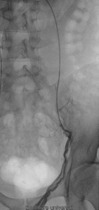 Embolisation varices pelviennes Centre Varices Pelviennes