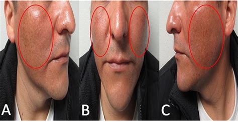 doxycycline rash from sun