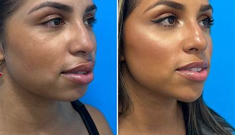 Dr. Steven Denenberg's facial plastic surgery before and afters: Chin