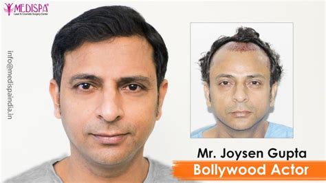 dr khan hair transplant banjara hills