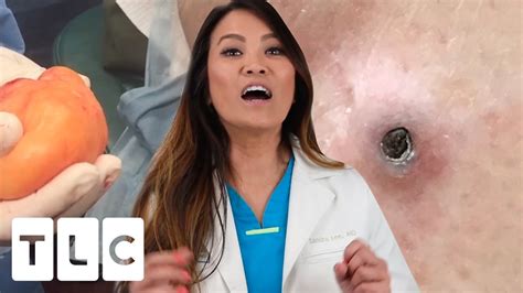 dr sandra lee blackheads