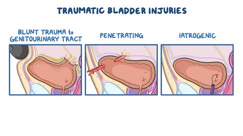 Drain Bladder Burst