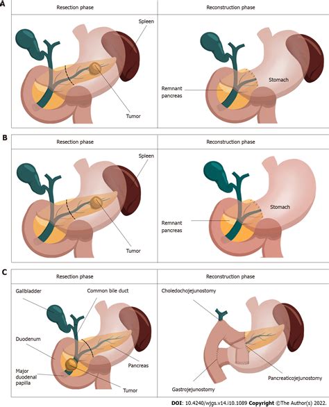 Drain Leaking After Surgery
