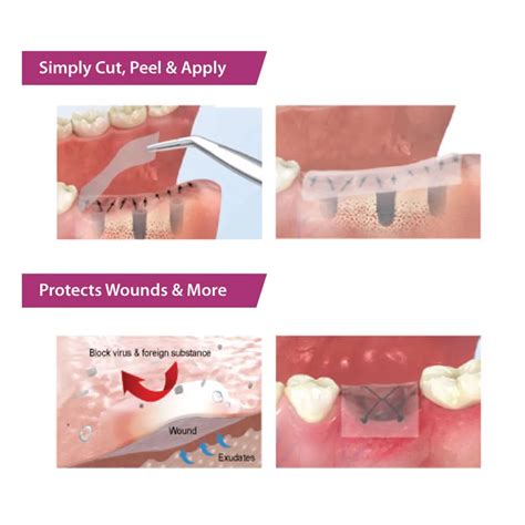 Dressing Oral Surgery