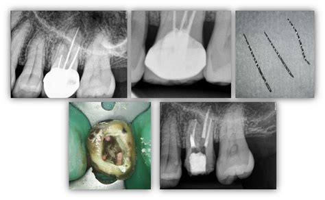 Drill Bit Broke During Root Canal