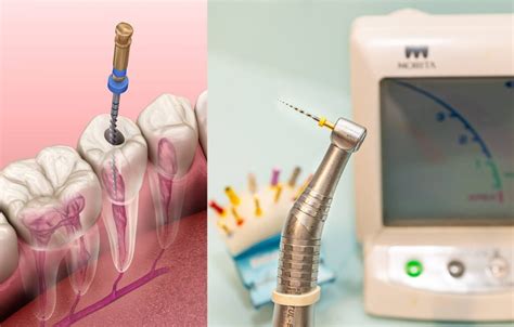 Drill Bit Left In Root Canal