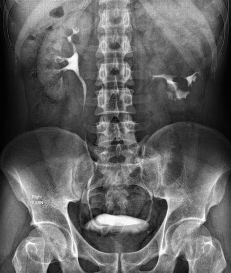 Drooping Lily Kidney