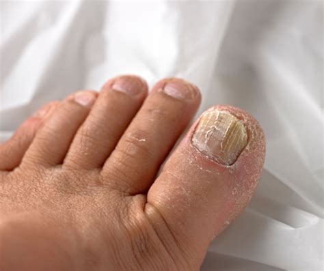 Dry Crusty Toenails