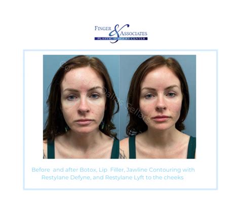 Dry Lips Jaw Surgery