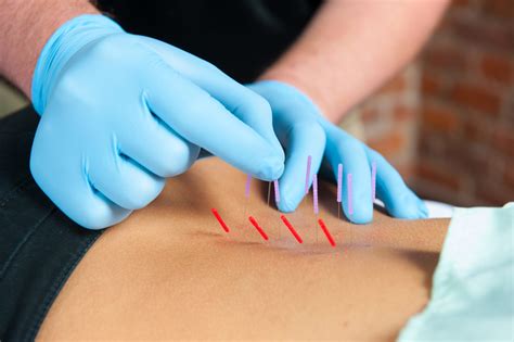 Dry Needling Courses Certification