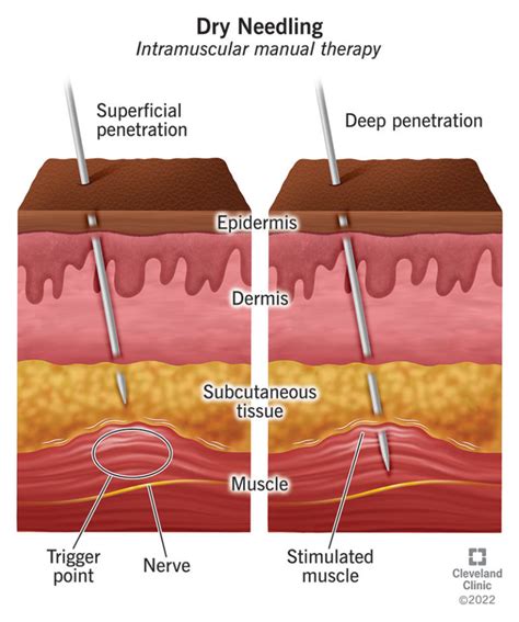 Dry Needling How Long Does It Last