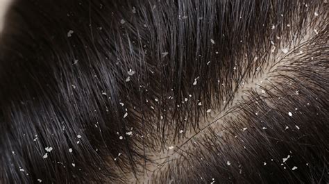 Dry Shampoo Causing Dandruff