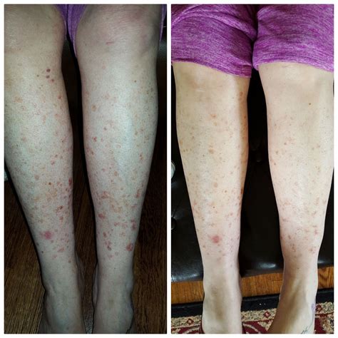 dsap treatment before and after