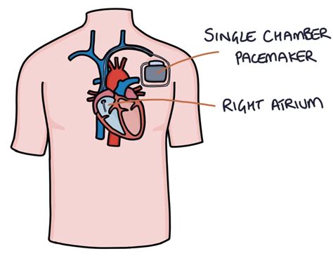 dual chamber vs single chamber pacemaker
