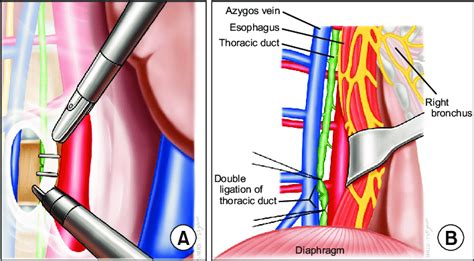 Duct Ligation Definition