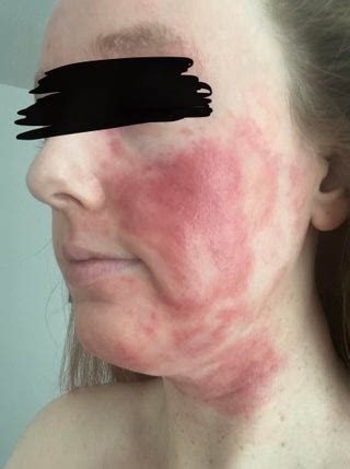 dupixent reviews facial redness