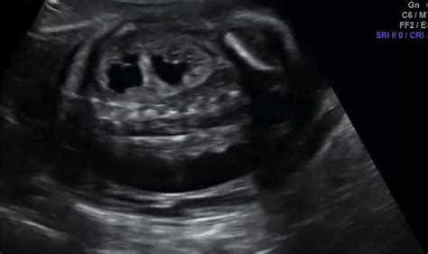 duplex kidney fetal ultrasound