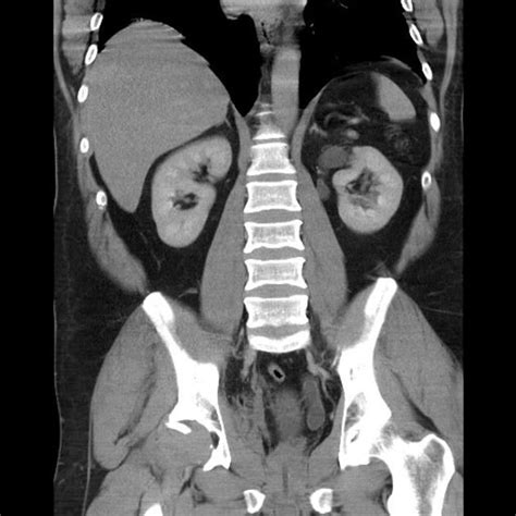 duplex kidney radiology