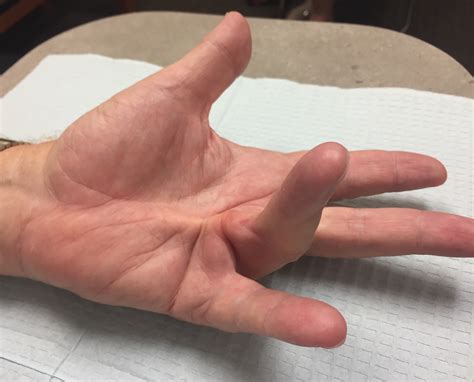dupuytren's contracture surgery