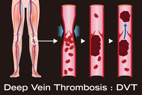 Understanding DVT in Leg: Causes, Symptoms, and Effective Treatments
