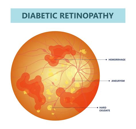 dwp points for glaucoma and diabetes