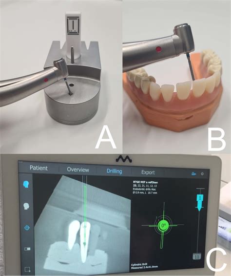 Dynamic Navigation System In Endodontics