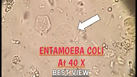 e coli in the stool