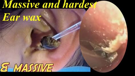 hard impacted ear wax removel in one stroke YouTube