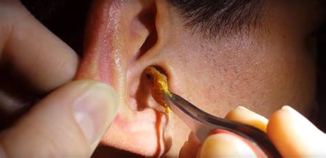 When to Clean out Earwax ATTN
