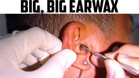 Murnine Ear Wax Removal System Green Valley Pharmacy