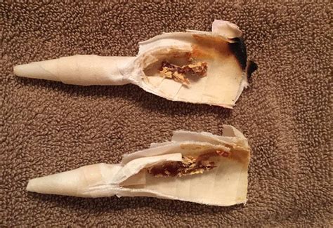 Man Has Gross Amount of Ear Wax Removed from Ear Canal Rare
