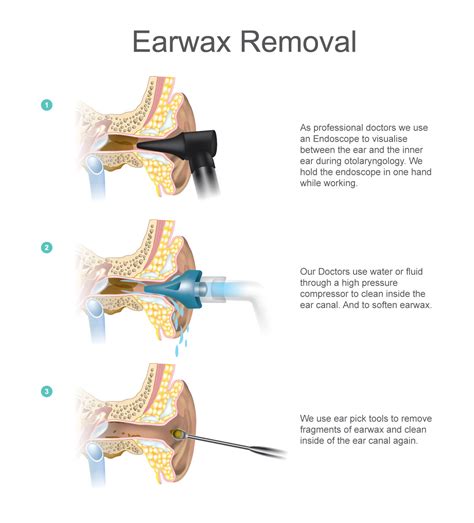 Six Tips on Earwax Removal in 2020 Ear wax, Natural lubricant, Tips