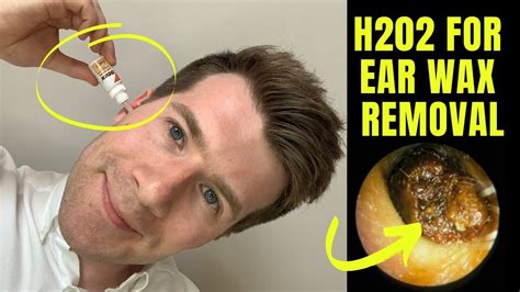 How to Use Hydrogen Peroxide To Remove Earwax? YouTube