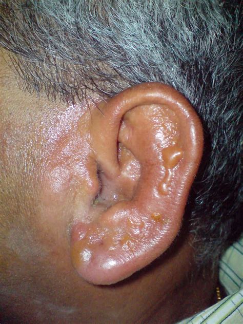 Ear Drops Allergic Reaction