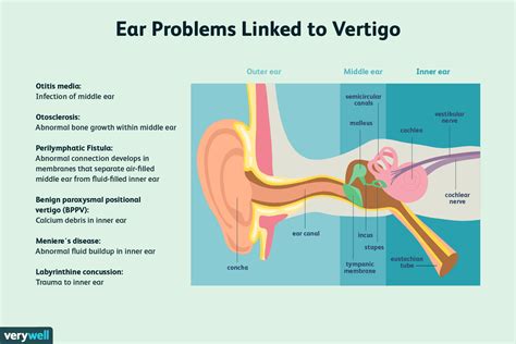 Ear Drops Cause Vertigo