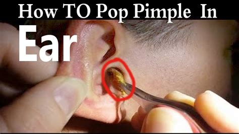 ear pimple pop