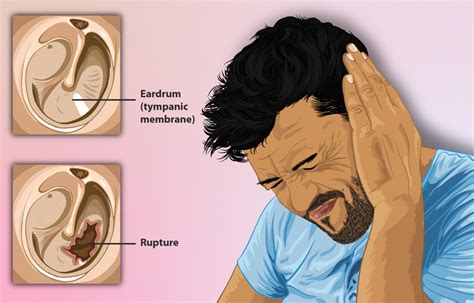 Understanding Ear Rupture Pain: Causes, Symptoms, and Effective Relief Options